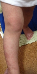 2月のレーザー治療、右足の経過