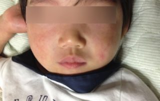 熱、アトピー、血管腫の関係